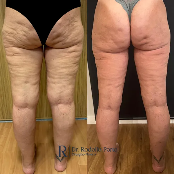 ANTES E DEPOIS 002