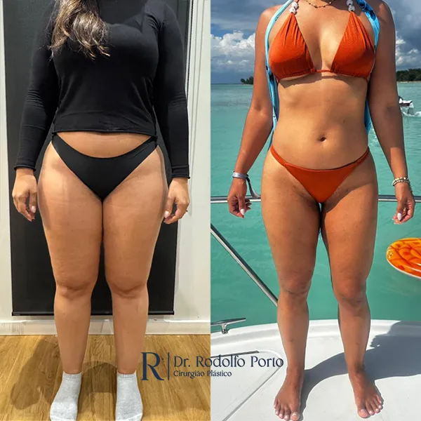 ANTES E DEPOIS 003