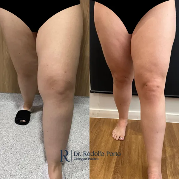ANTES E DEPOIS 004