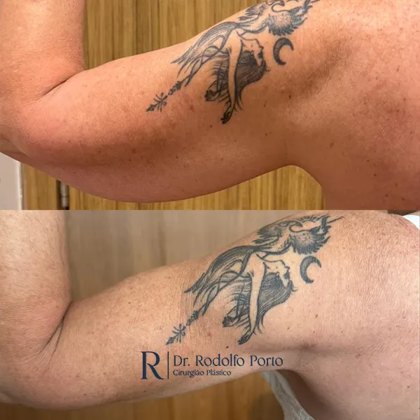 ANTES E DEPOIS 005