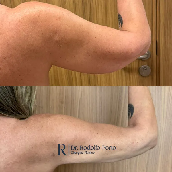 ANTES E DEPOIS 006