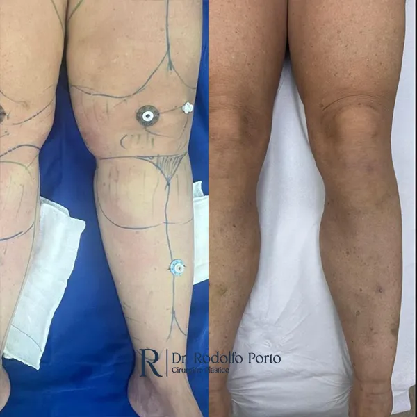 ANTES E DEPOIS 008