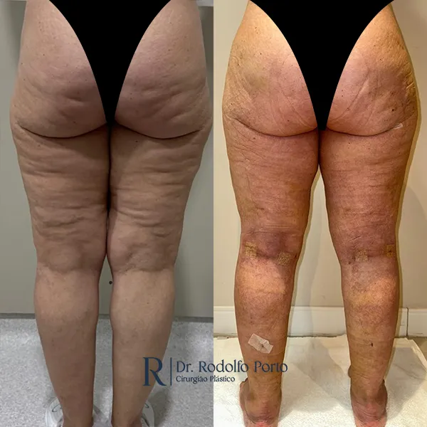 ANTES E DEPOIS 009