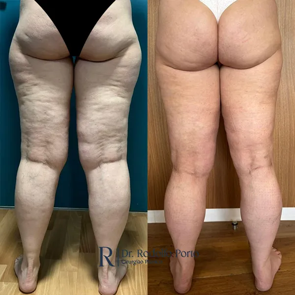 ANTES E DEPOIS 010