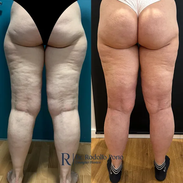 ANTES E DEPOIS 011